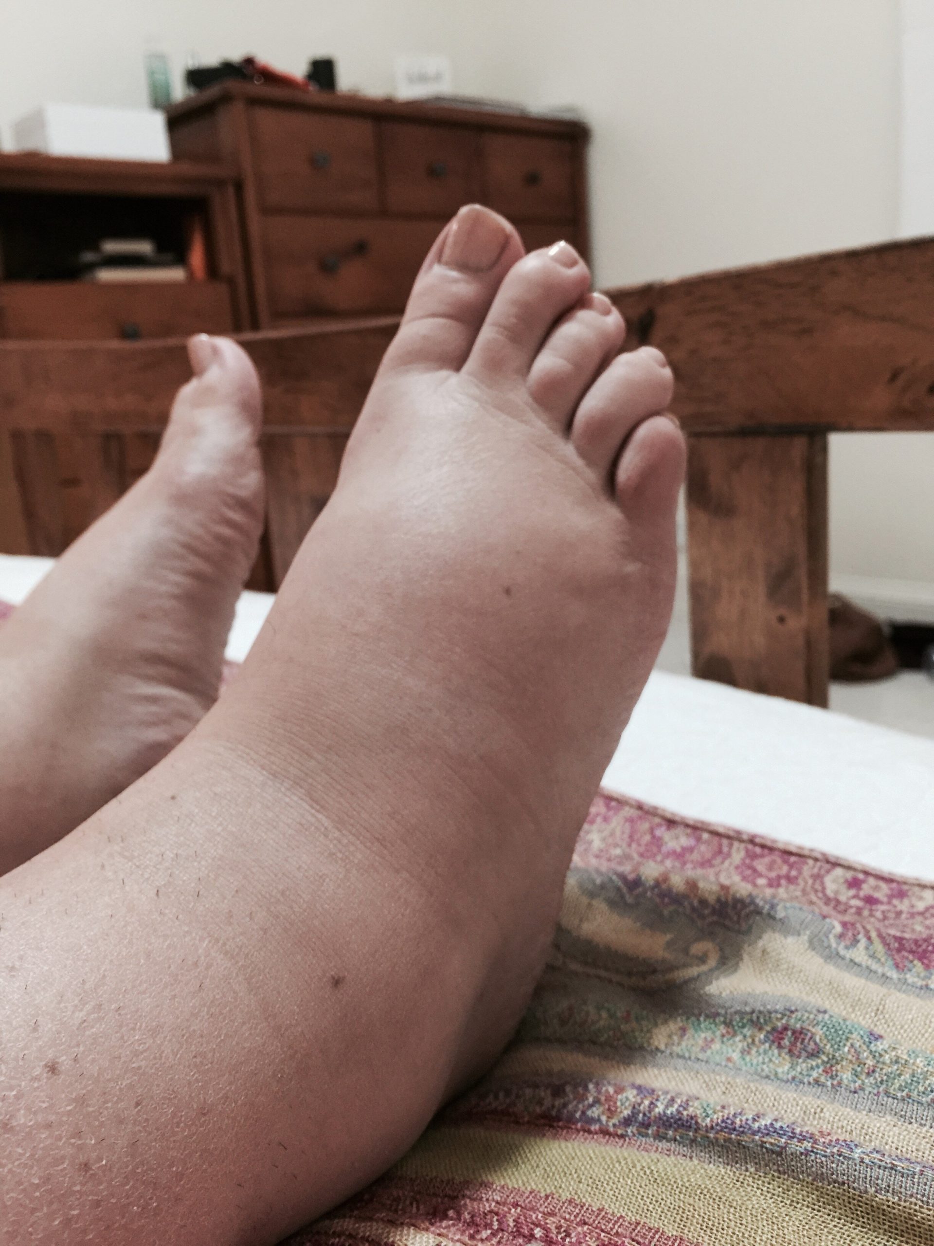 My Lymphoedema and Lipoedema Journey Kimmi Katte